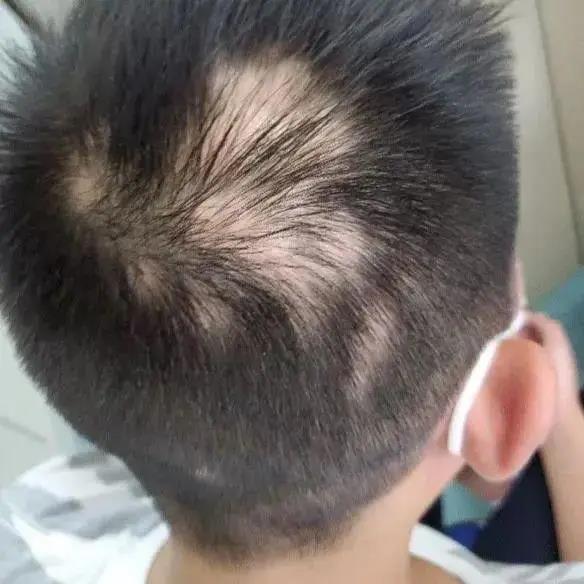 12歲男孩，學(xué)到頭禿
